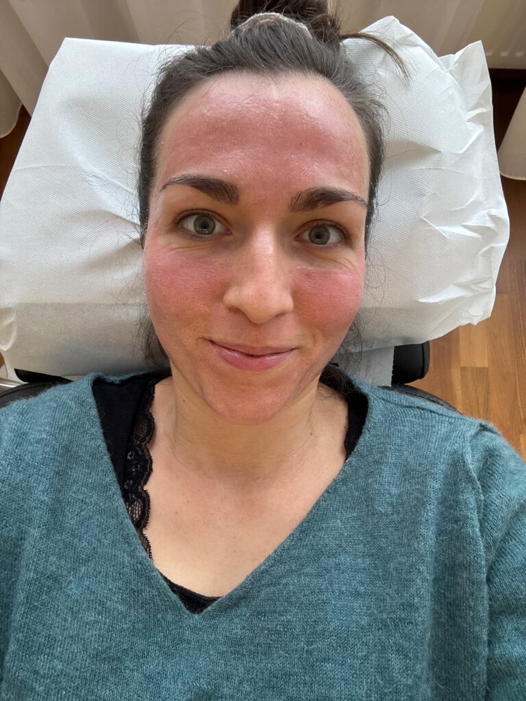 Microneedling Nebenwirkung