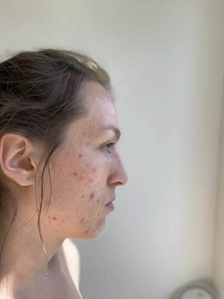 Hanna mit sichtbarer Akne im Profil