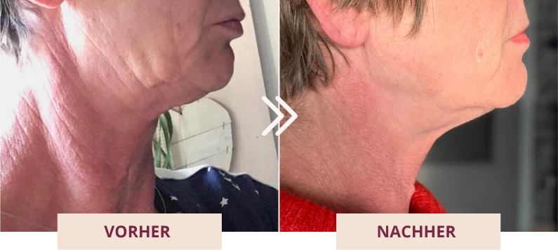 Vorher-Nachher-Vergleich von Martina Schlütter: die Halspartie ist nach dem Training deutlich straffer.